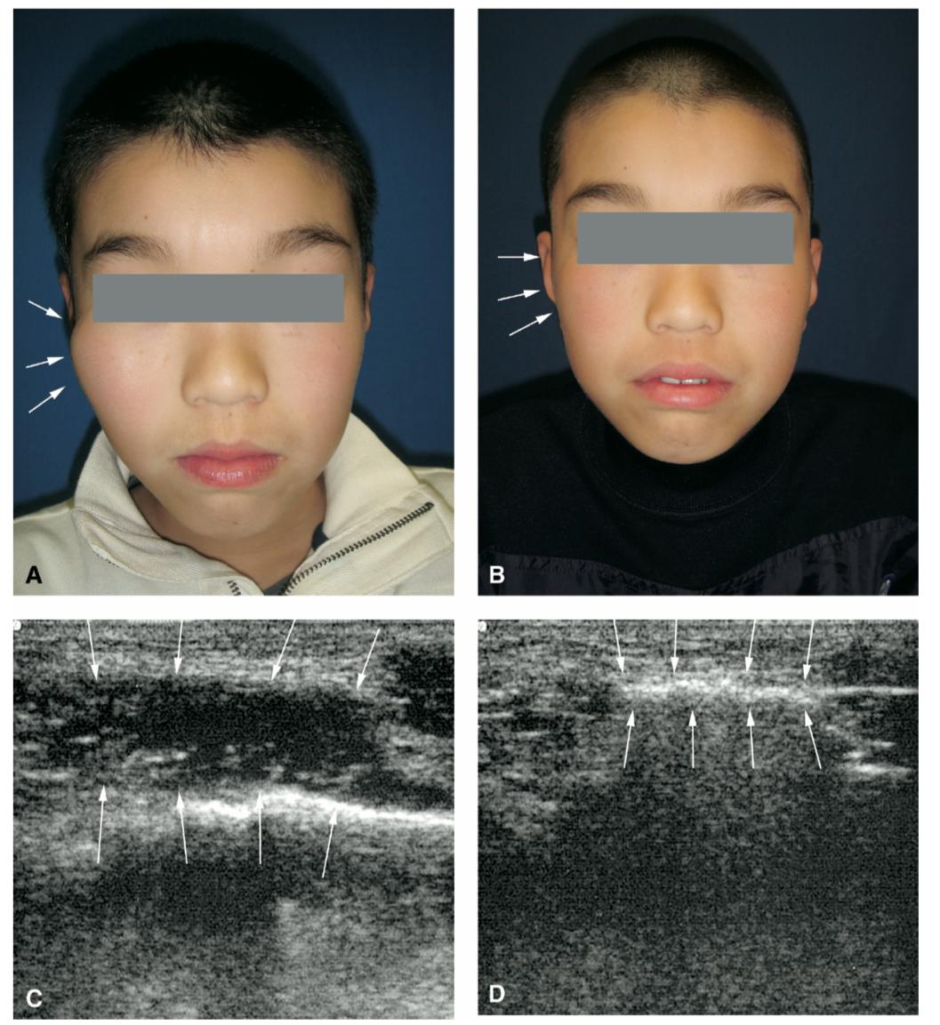 什么样的血管畸形不能打硬化剂,儿童血管畸形硬化过程