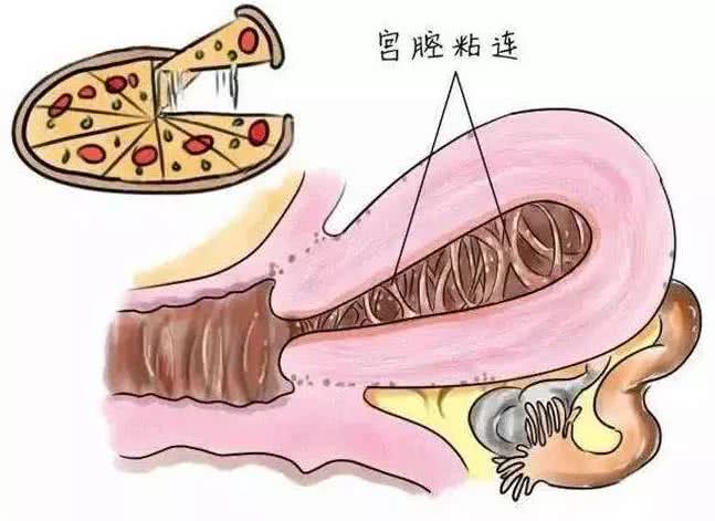 做过人流老公会发现吗,瞒着男朋友做了人流