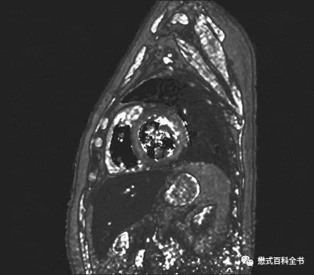 心脏磁共振定位方法,心脏磁共振各参数分析