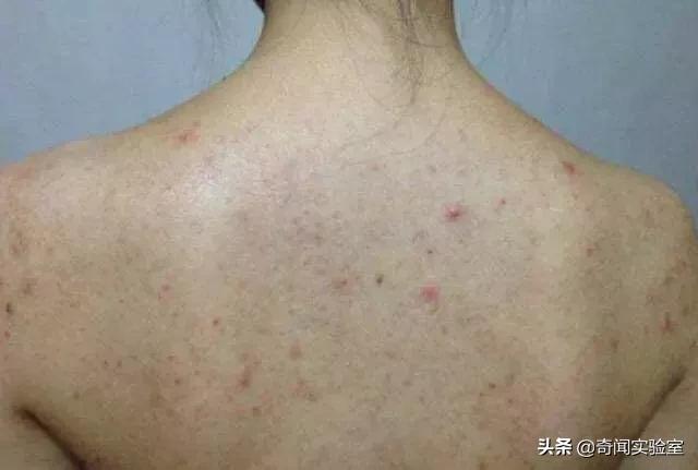 洗澡后背自己洗不掉怎么办,洗澡后背搓不到泥怎么回事