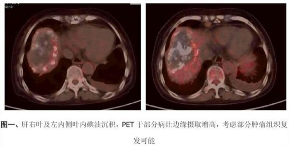 癌症转移无症状,癌症全身转移抗癌成功案例