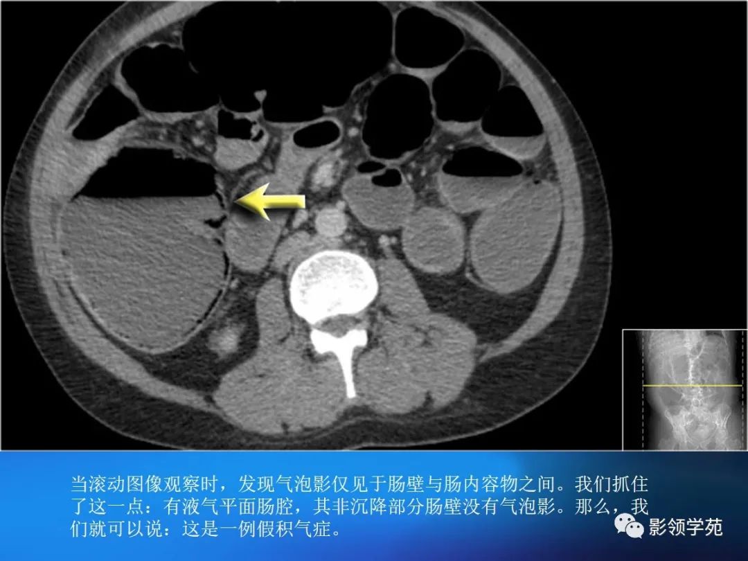 肠道内壁增厚,肠道扩张ct表现