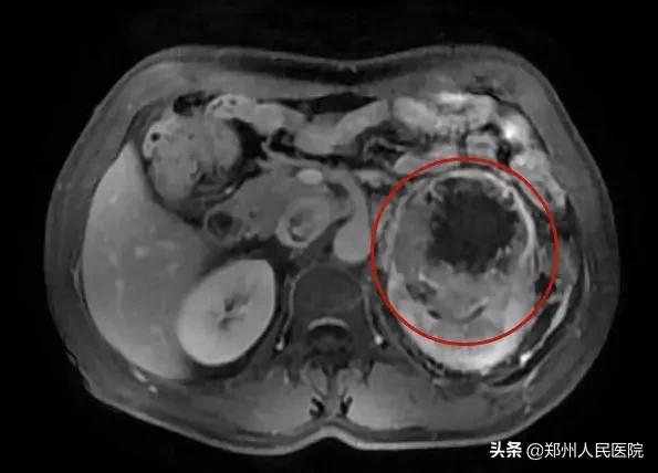 尿血需警惕吸烟也可能引起膀胱癌,尿血要警惕三种疾病