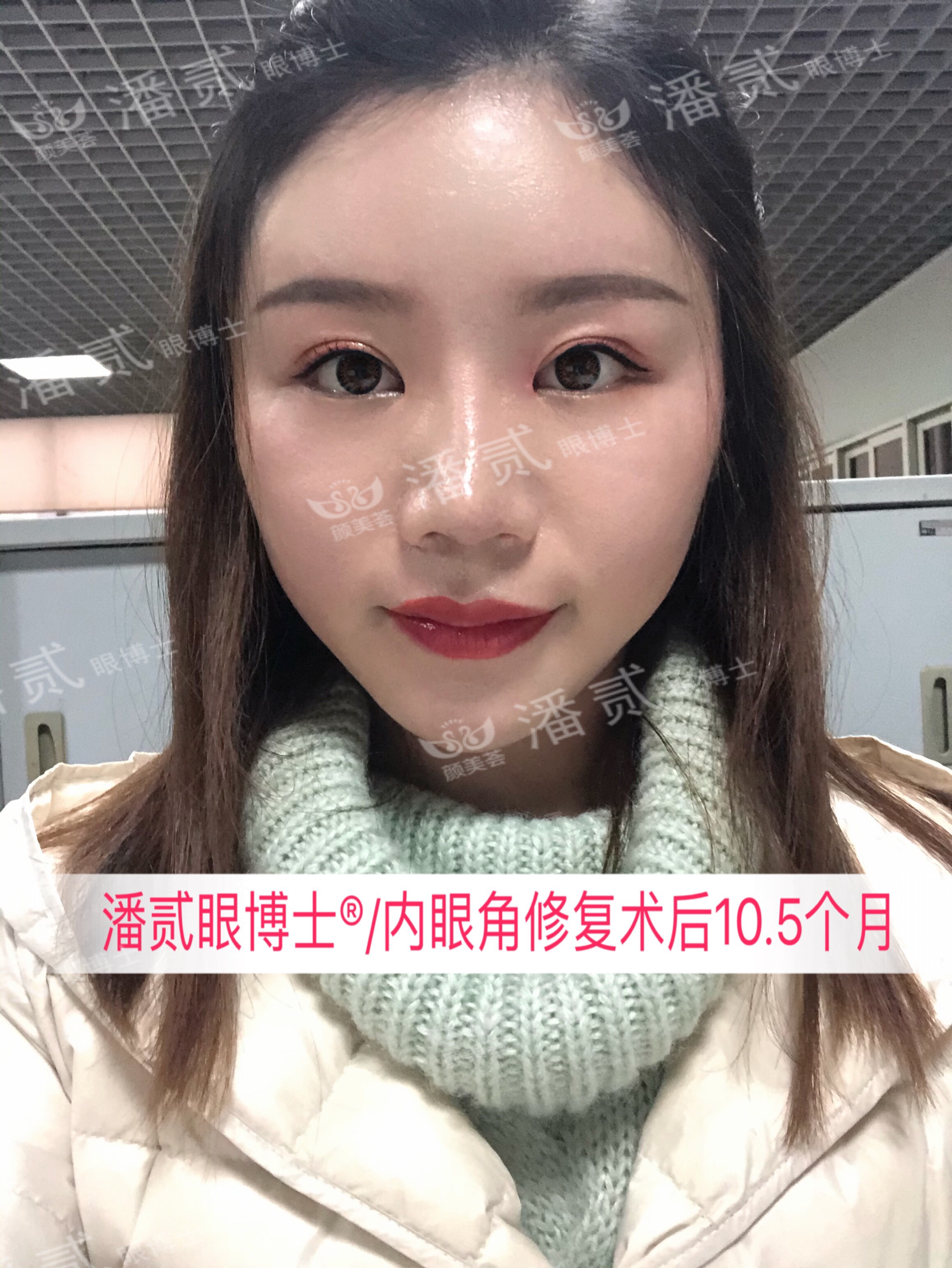 开内眼角会留疤的照片,开内眼角的疤痕变白色了怎么办