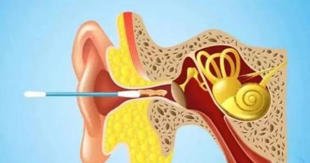 用棉签掏耳朵是不是越弄越堵,用棉签掏耳朵会不会越套越厉害