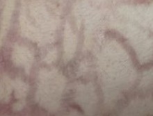 小伙腿上银屑病,男大学生截肢事件