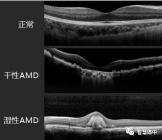 年龄相关性黄斑变性辅助检查,年龄相关性黄斑变性