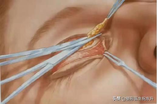 切开法双眼皮,切开双眼皮修复后多久可以再修