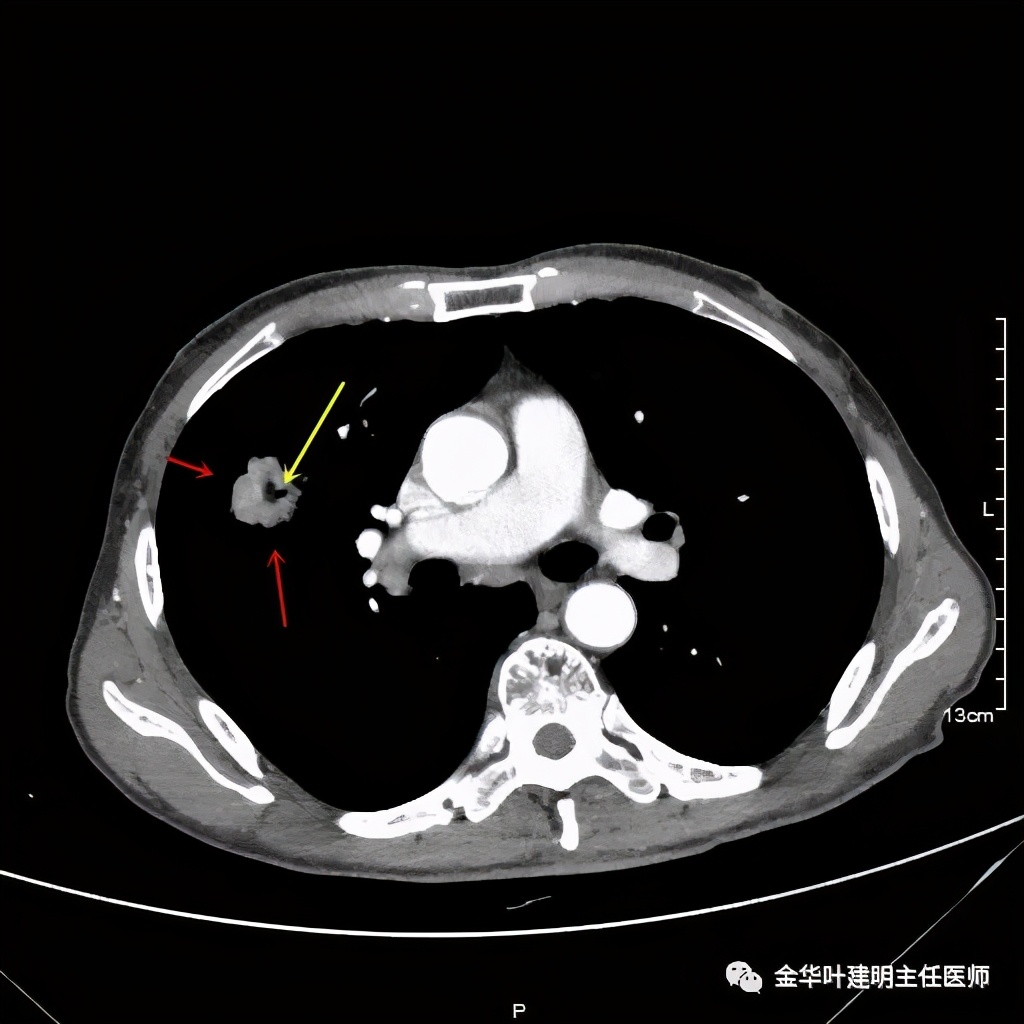 左肺占位被安排穿刺活检是肺癌吗,肺癌肺部穿刺有什么危险