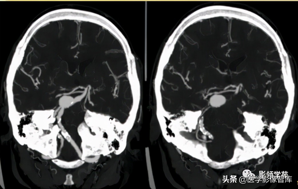 鞍区肿瘤做什么检查得出来,鞍区肿瘤的影像学鉴别