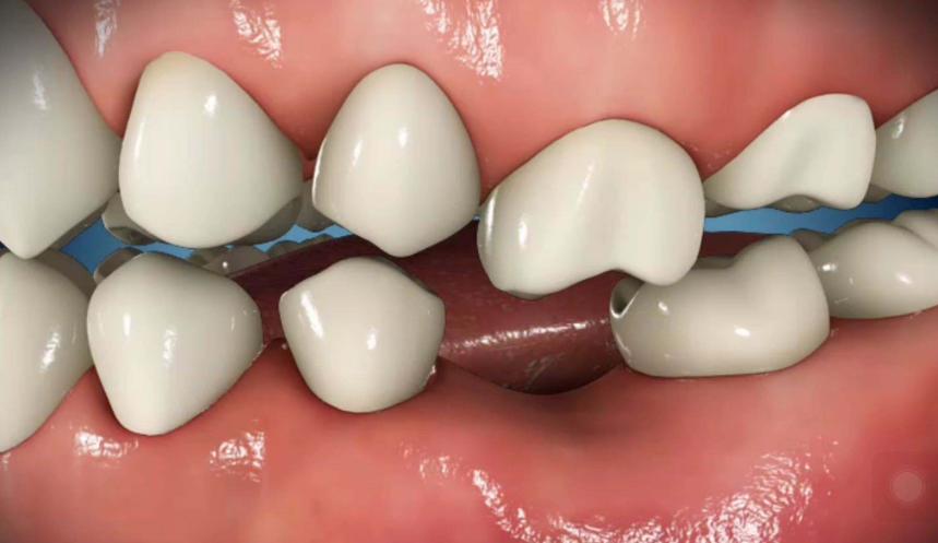 同样是补牙，为什么差距那么大？不同的补牙材料到底该怎么选？