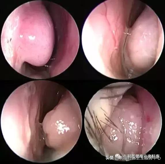 过敏性鼻炎手术的全过程,治疗过敏性鼻炎有效的药