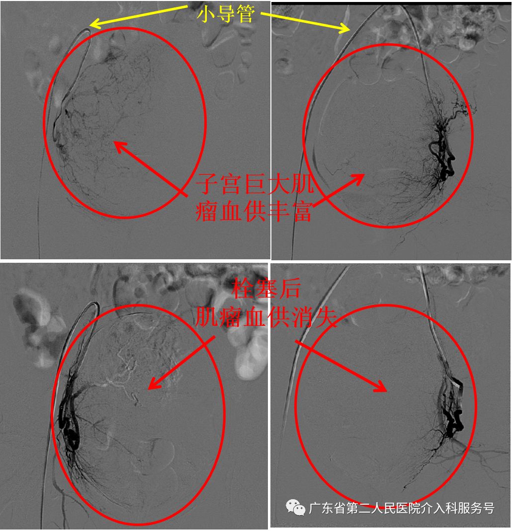 子宫肌瘤引起“大姨妈”排山倒海,淋沥不净……针眼妙方解除烦恼