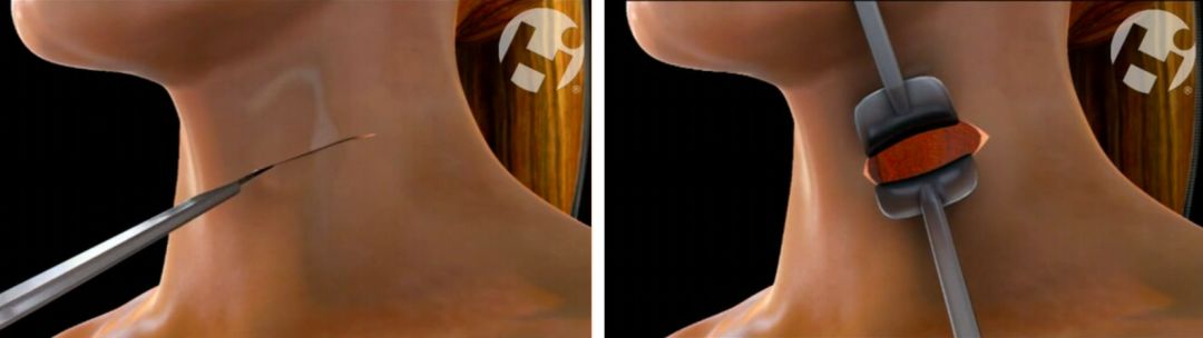 颈椎病是保守治疗还是手术治疗好,颈椎病做什么手术比较安全