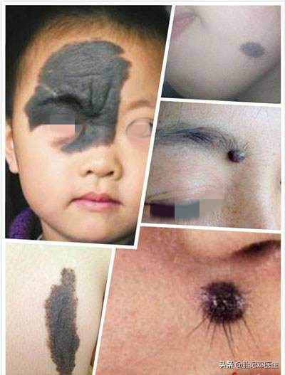 黑毛痣容易出现恶化病变吗