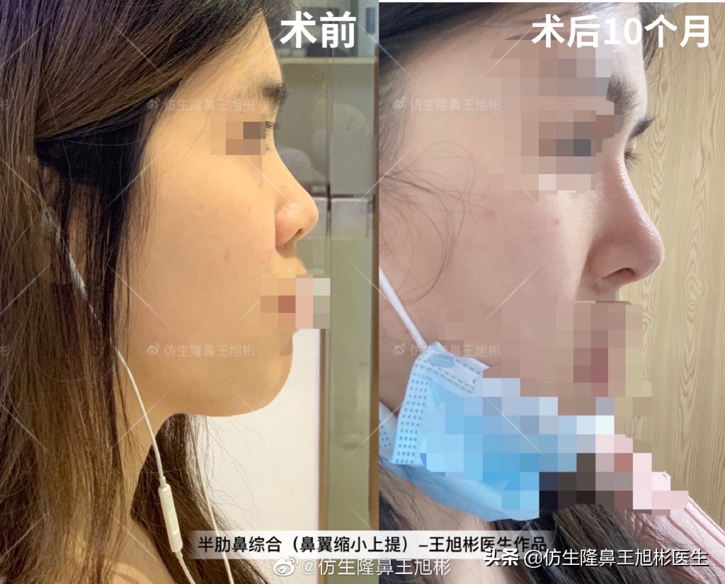 那些被鼻子“封印”颜值的鼻综合/修复案例|广州鼻整形