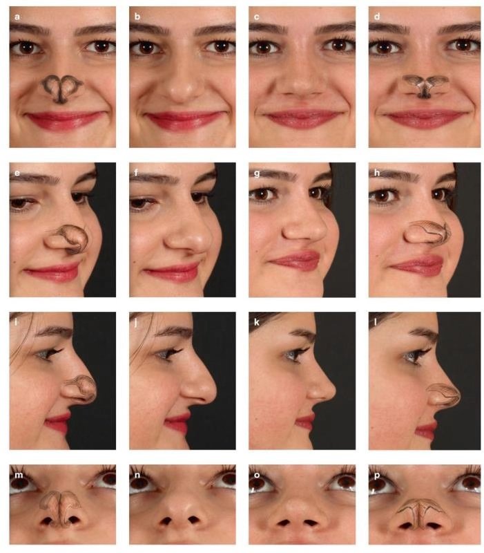 鼻头高度不够怎么办,我的鼻头老是红的怎么办