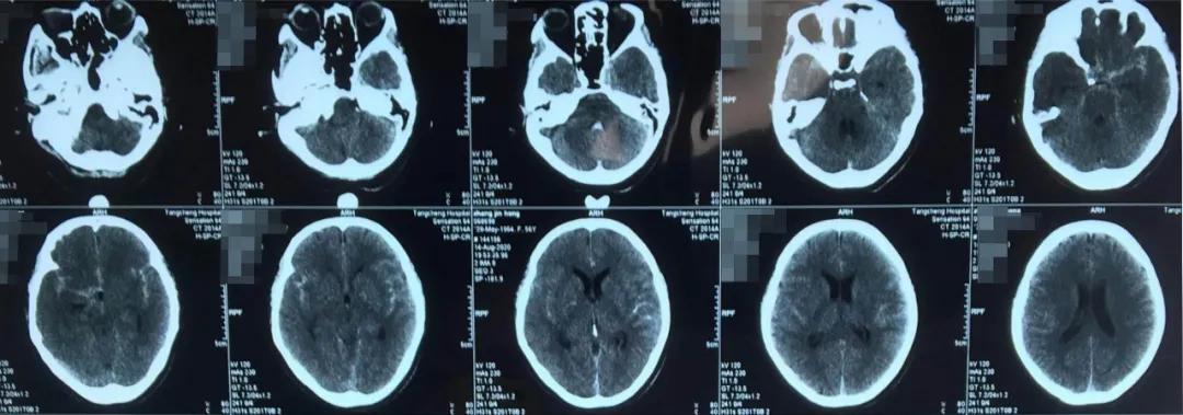 惊心动魄的心血管介入手术,脑动脉瘤开颅的全过程实例