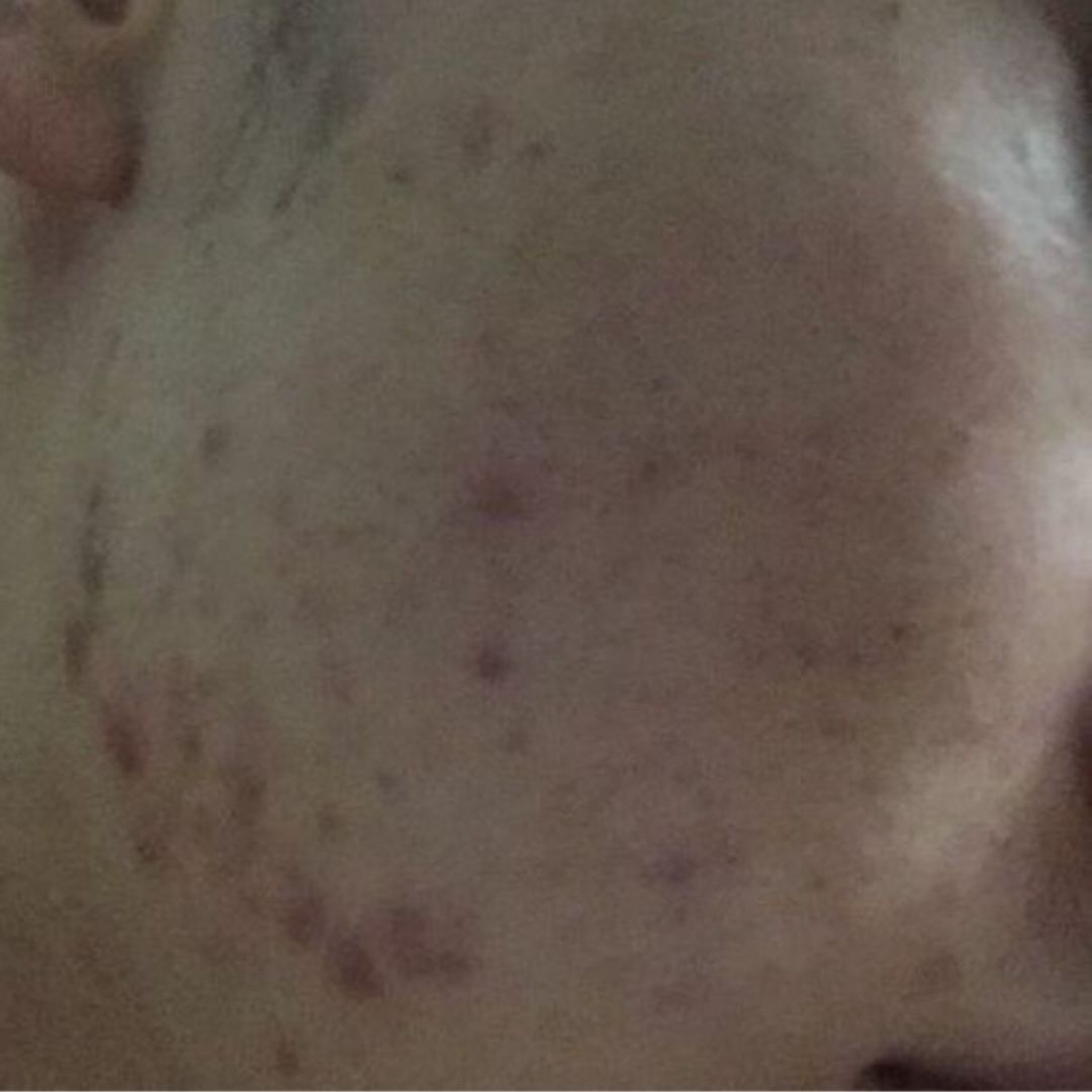 祛痘印的方法怎么可以快速祛痘印,怎样有效快速祛痘祛痘印