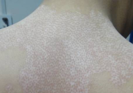 白癜风好转的十大征兆,你的白癜风出现在哪个部位呢