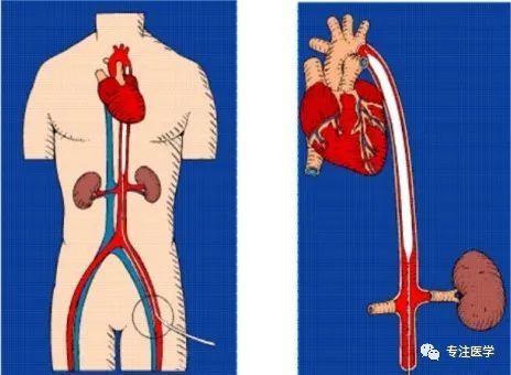 无造影剂冠脉介入治疗,冠脉介入术后护理及并发症
