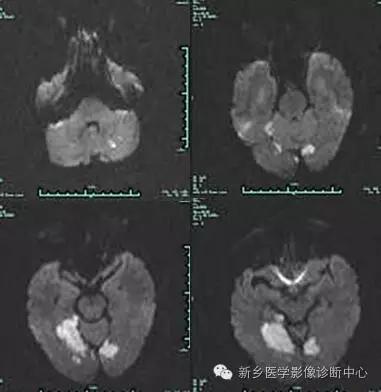 基底动脉尖综合征患者溶栓,基底动脉尖综合征名词解释