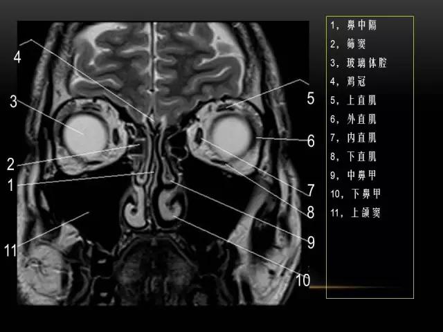 鼻腔鼻窦及颅底ct影像解剖,鼻窦解剖mri