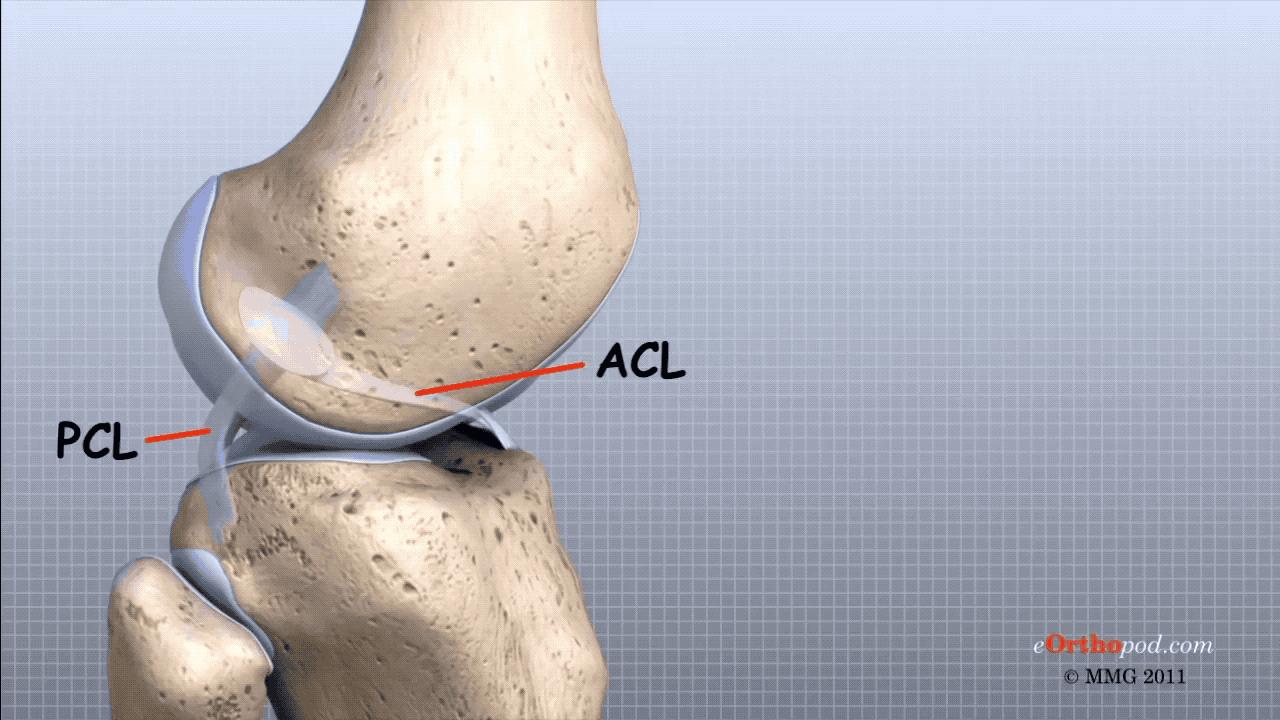 判断前交叉韧带断裂最简单的方法,前十字交叉韧带撕裂自测