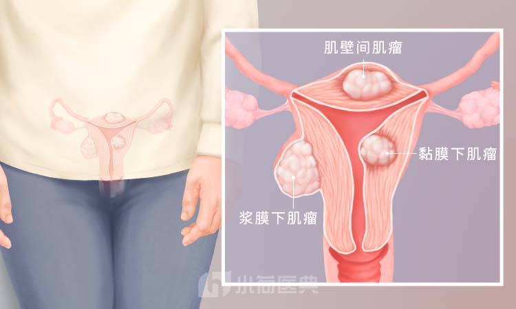 子宫肌瘤手术是小手术还是大手术,得了子宫肌瘤怎么办