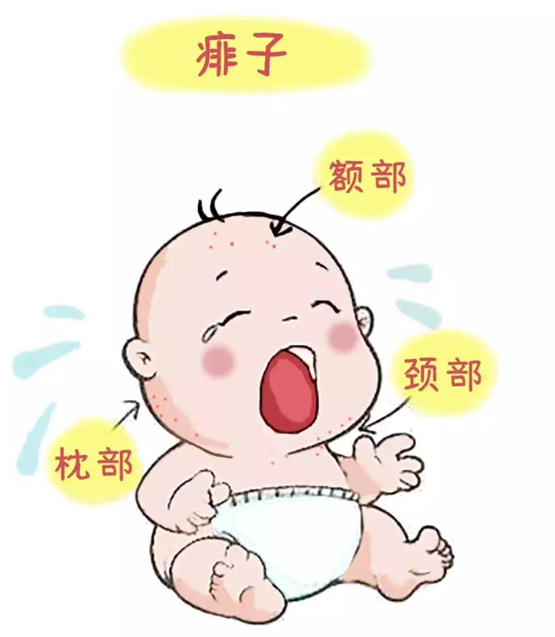 痱子反反复复偏方,中医痱子怎么消除