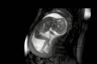 孕妇肚子一跳一跳的是宝宝打嗝吗,胎动一跳一跳的是胎儿打嗝吗