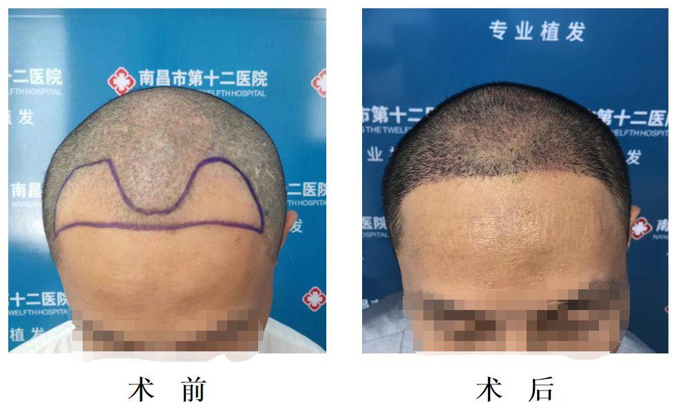 头发种植手术是如何种植的,头发种植利弊有哪些呢