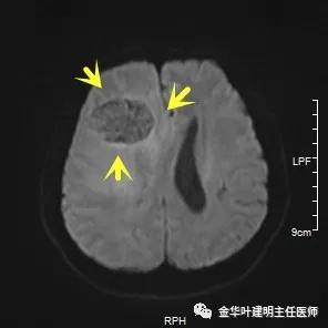 伴有脑转移了的肺癌能手术吗？