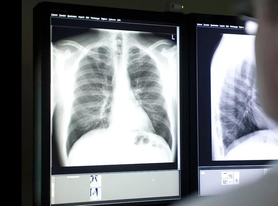 怎么才会导致胰腺炎,得了胰腺炎怎么能发展到胰腺癌