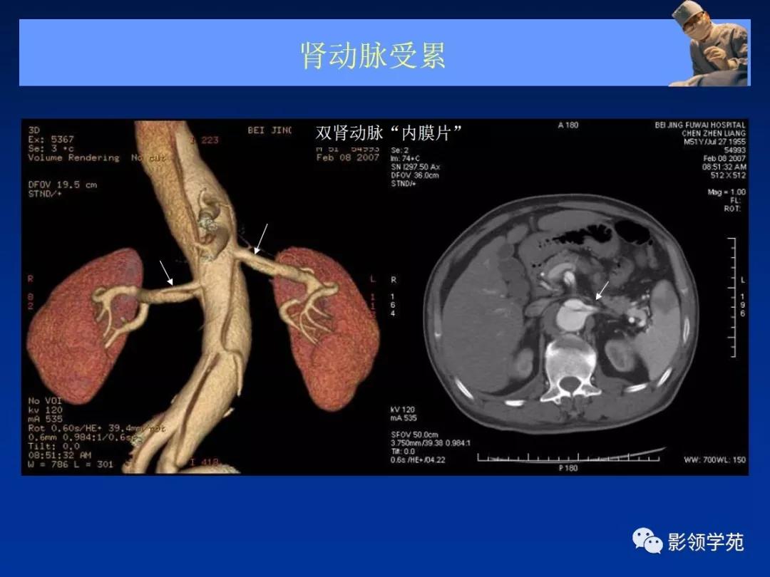 主动脉夹层壁间血肿如何鉴别,主动脉夹层血肿溃疡