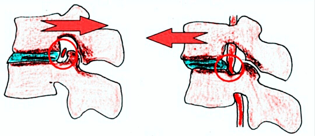 腰椎退行性变诊断书怎么写,腰椎退行性滑脱最好的治疗方法