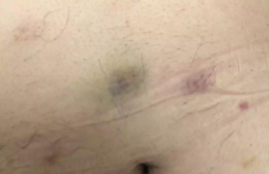 打肝素针打肚皮的时候进血了,打低分子肝素针怎么好扎