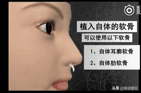 隆鼻失败的常见原因有哪些,隆鼻失败最快的解决方法