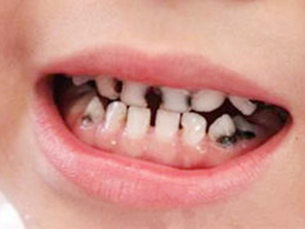 小孩满口牙蛀牙是怎么回事,孩子满嘴蛀牙严重能修复吗