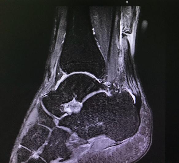 跟腱手术后康复用什么药,跟腱术后需要注意什么