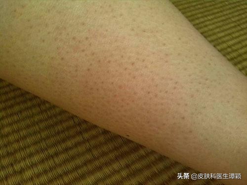 去医院皮肤科能治鸡皮肤吗,皮肤科医生鸡皮