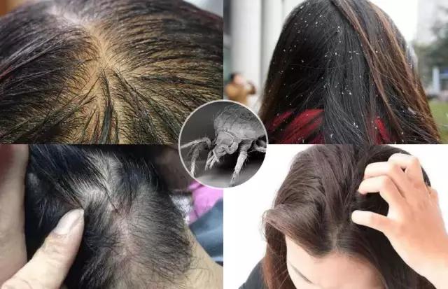 头皮一直出汗痒,头皮多痒出油掉发严重怎么办