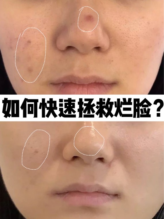 干货烂脸修复术学起来拯救敏感肌,手把手教你修复烂脸