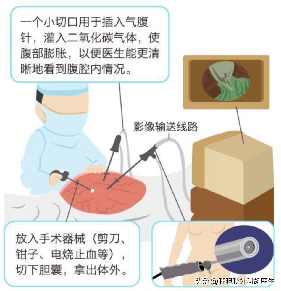 得了急性胆囊炎该怎么办？