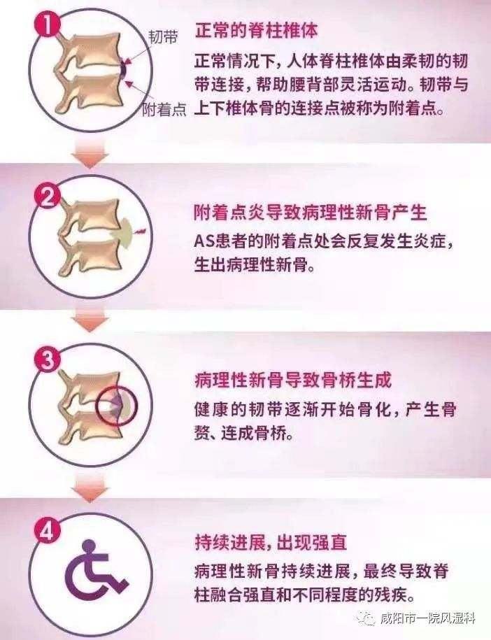 强直性脊柱炎号称不死的癌症,咸阳市强直性脊柱炎定点医院
