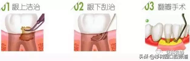 牙疼的滋味没人能理解,牙疼的痛苦有谁能够体会