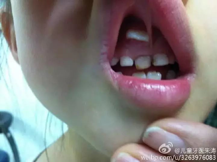 修复一颗蛀牙的全过程,蛀牙早期黑点全治好了的感觉真好