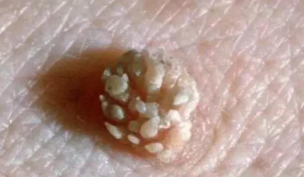 脸上长了像黑痣一样的东西,脸上长了像痘痘的东西是啥