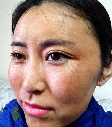 除皱小妙招,真性皱纹最快的除皱方法