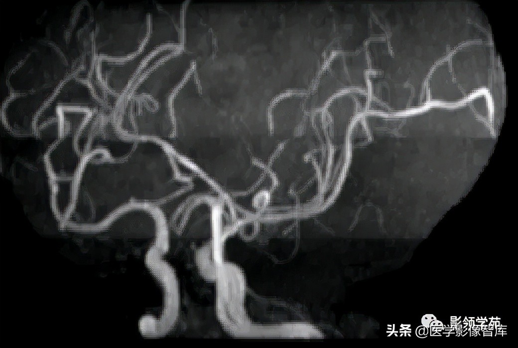 鞍区肿瘤做什么检查得出来,鞍区肿瘤的影像学鉴别